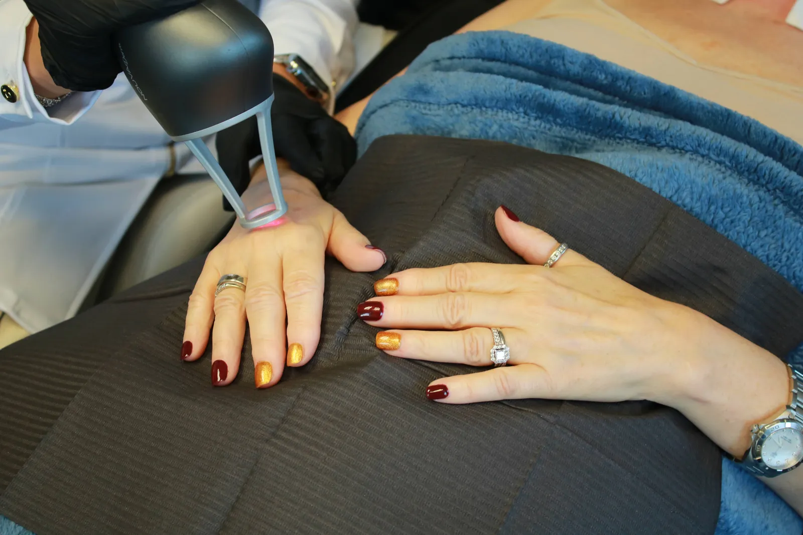 Can Nouvaderm Laser Treat Sun Spots, Acne Marks & Age Spots?
