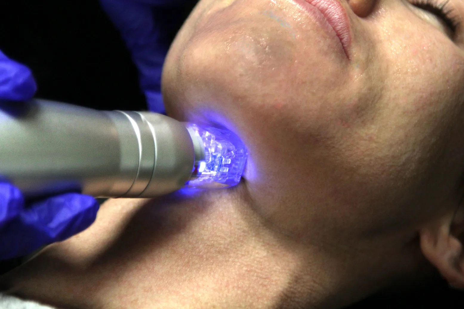Scarlet RF microneedling