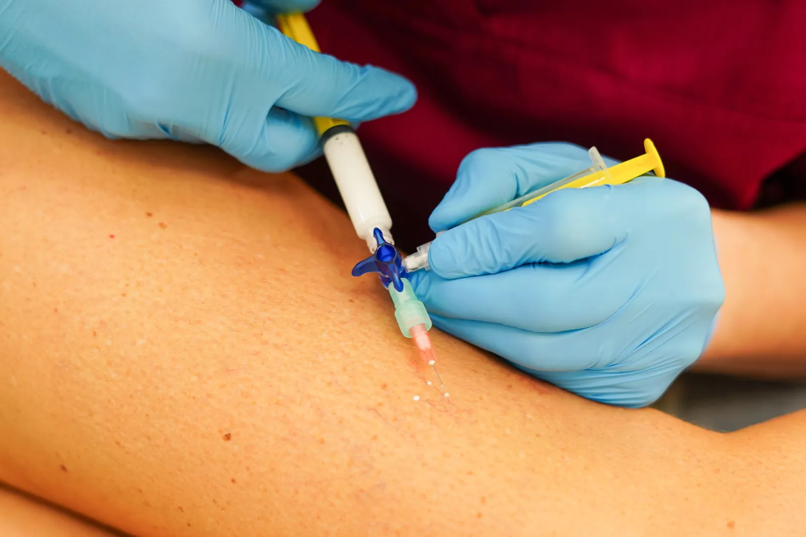 Sclerotherapy
