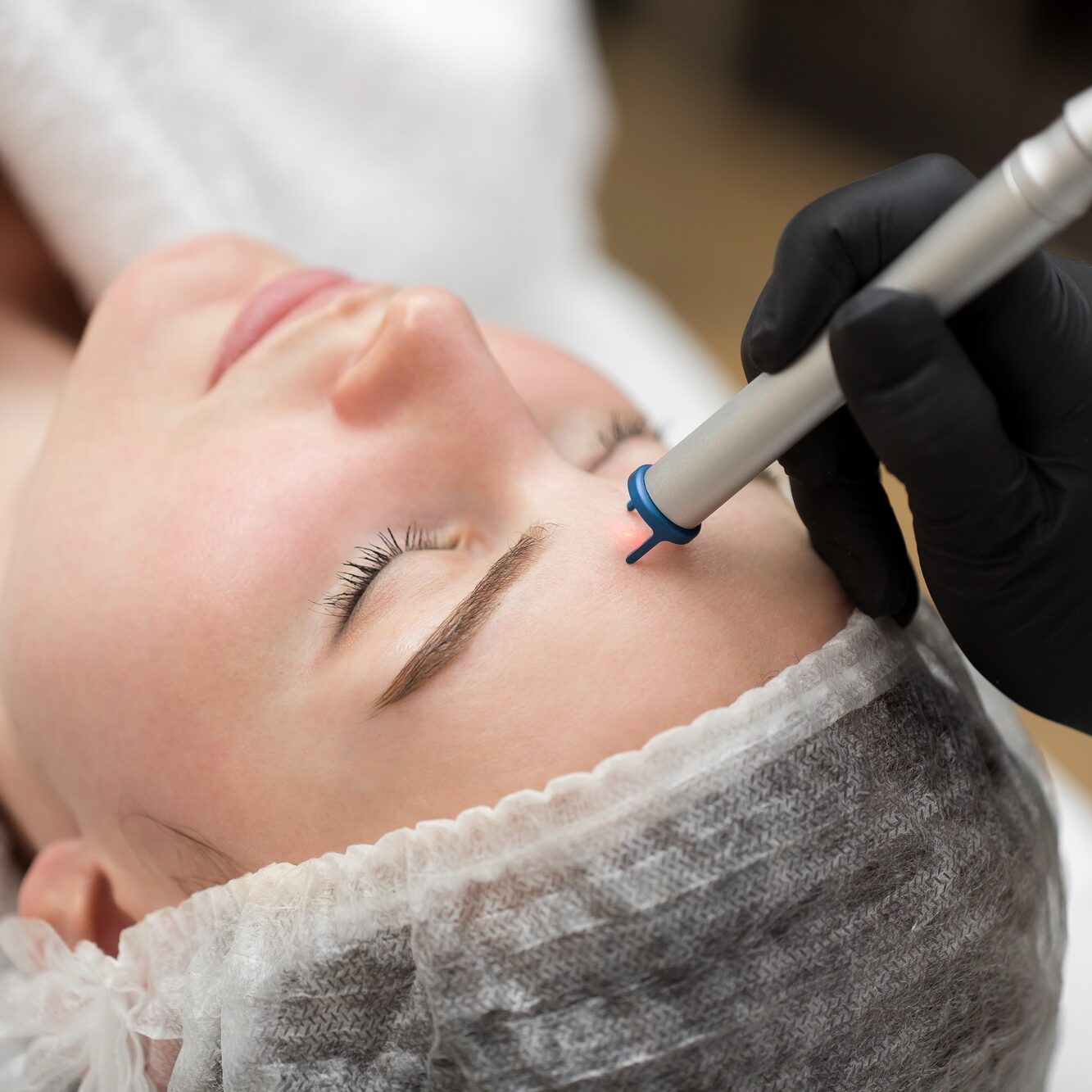 Close-up removal of blood vessels on the face of a diode laser in a cosmetic clinic.