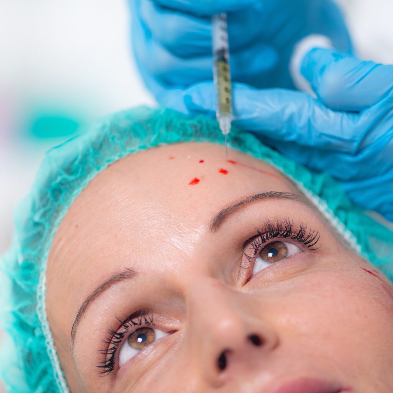 PRP or Platelet Rich Plasma Cosmetic Face Treatment